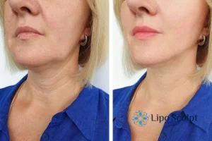 Double chin before and after Hi-Fu treatment 4 Book your double chin treatment Hemel Hempstead today! We are here to help!