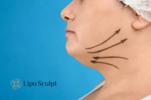 Double chin before and after Hi-Fu treatment 3 Boost your confidence with a Double chin treatment Hemel Hempstead