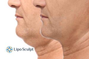Double chin before and after Hi-Fu treatment 2 Double chin treatment Hemel Hempstead from Lipo Sculpt - feel more confident today!