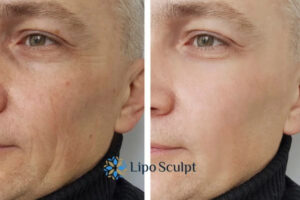 How to Fight Aging Symptoms 3 Fight Aging Symptoms Hemel Hempstead With HIFU and Morpheus8 Today!