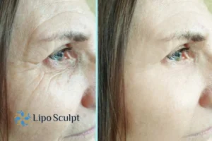 How to Fight Aging Symptoms 2 Do you want to Fight Aging Symptoms Hemel Hempstead? Contact Lipo Sculpt today!