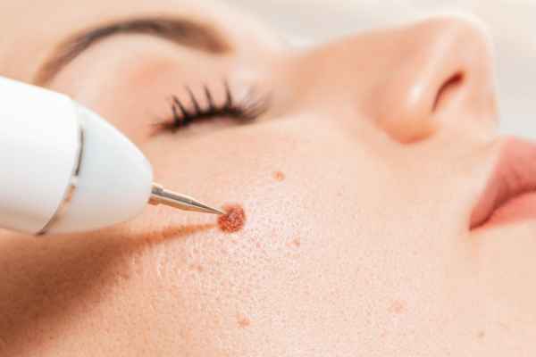 CryoPen: 5 Skin Concerns It May Be Used to Treat 3 What actually happens during a CryoPen treatment Hemel Hempstead?