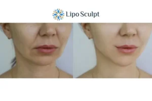 Explaining Total Skin Tightening Treatment And What It Can Do For You 2 Do you want to boost your self confidence? Give Morpheus8 Hemel Hempstead a try today!