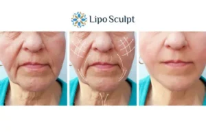 Explaining Total Skin Tightening Treatment And What It Can Do For You 3 Boost your confidence with Morpheus8 Hemel Hempstead call our team today!