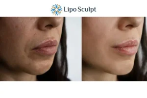 Explaining Total Skin Tightening Treatment And What It Can Do For You 4 Morpheus8 Hemel Hempstead the best results - call our team today!