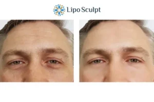 Explaining Total Skin Tightening Treatment And What It Can Do For You 6 Morpheus8 Hemel Hempstead book in today to find out more!