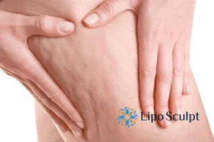 CoolSculpting for Legs: The Innovative Approach to Redefining Your Legs 5 Start your journey today book your coolsculpting treatment Hemel Hempstead online today!