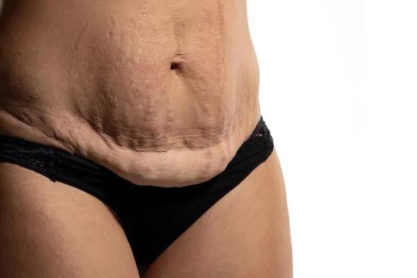 Lost the Weight but Not the Loose Skin? 1 image of womans stomach after weight loss showing loose skin Hemel Hempstead